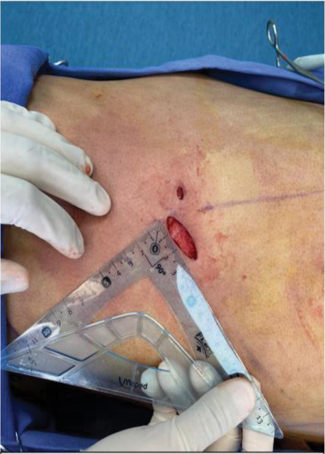 View of Rib removal in body contouring surgery and its influence on the  waist