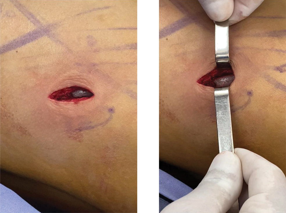 View of Rib removal in body contouring surgery and its influence on the  waist