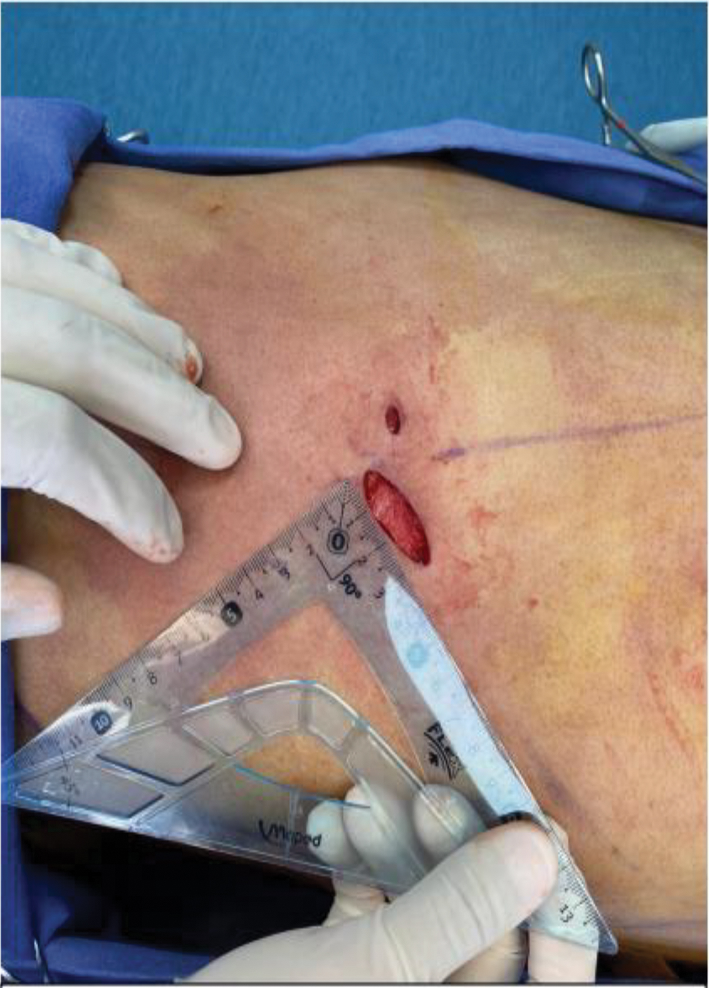 Rib removal in body contouring surgery and its influence on the
